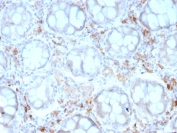 IHC staining of FFPE human colon carcinoma with recombinant CD209 antibody (clone rC209/1781). HIER: boil tissue sections in pH 9 10mM Tris with 1mM EDTA for 10-20 min and allow to cool before testing.