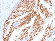 FOXA1 Antibody Prostatic Intraepithelial Neoplasia (PIN) IHC. Immunohistochemical staining of FFPE human prostatic intraepithelial neoplasia (PIN) tissue using FOXA1 Antibody (clone FOXA1/1516) demonstrates strong nuclear HRP-DAB brown staining within dysplastic prostatic epithelial cells. The staining pattern is consistent with expression of FOXA1, a forkhead family transcription factor that functions as a developmental regulator of gene expression, epithelial differentiation, and tissue-specific transcriptional programs. The prominent nuclear localization is characteristic of a DNA-binding transcription factor and supports the role of FOXA1 in maintaining epithelial lineage identity and regulating gene networks associated with cellular differentiation and prostate epithelial biology. HIER: steam sections in pH 9 10 mM Tris with 1 mM EDTA for 10-20 minutes and allow to cool before testing.