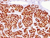 FOXA1 Antibody Human Prostate IHC. Immunohistochemical staining of FFPE human prostate tissue using FOXA1 Antibody (clone FOXA1/1516) demonstrates strong nuclear HRP-DAB brown staining throughout prostatic epithelial cell populations. The staining pattern is consistent with expression of FOXA1, a forkhead family transcription factor that functions as a developmental regulator of gene expression, epithelial differentiation, and tissue-specific transcriptional programs. The prominent nuclear localization is characteristic of a DNA-binding transcription factor and supports the role of FOXA1 in maintaining epithelial lineage identity and regulating gene networks associated with prostate development, differentiation, and tissue homeostasis. HIER: steam sections in pH 9 10 mM Tris with 1 mM EDTA for 10-20 minutes and allow to cool before testing.