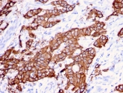 HER-2 Antibody Breast Tumor Glandular IHC. Immunohistochemistry analysis of FFPE human breast carcinoma tissue using HER-2 Antibody (clone ERBB2/3080) highlights prominent HRP-DAB brown membranous staining along gland-like tumor structures, emphasizing surface localization of ErbB2 / HER2 within epithelial tumor architecture, while adjacent stromal regions remain largely negative; nuclei are counterstained blue. HIER: boil tissue sections in pH 9 10 mM Tris with 1 mM EDTA for 10-20 min and allow to cool before testing.