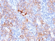 HER-2 Antibody Breast Tumor Heterogeneous IHC. Immunohistochemistry analysis of FFPE human breast carcinoma tissue using HER-2 Antibody (clone ERBB2/3080) demonstrates variable HRP-DAB brown membranous staining intensity across tumor regions, reflecting heterogeneous ErbB2 / HER2 expression within the tumor microenvironment, while stromal components show minimal background staining; nuclei are counterstained blue. HIER: boil tissue sections in pH 9 10 mM Tris with 1 mM EDTA for 10-20 min and allow to cool before testing.