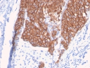 HER2 Antibody Breast Tumor Dense Membrane IHC. Immunohistochemistry analysis of FFPE human breast carcinoma tissue using HER-2 Antibody (clone ERBB2/3093) demonstrates intense, continuous HRP-DAB brown membranous staining in densely packed tumor cell regions, emphasizing high surface expression of ErbB2 / HER2 as a receptor tyrosine kinase, while surrounding stromal components show minimal background staining; nuclei are counterstained blue. HIER: boil tissue sections in pH 9 10 mM Tris with 1 mM EDTA for 10-20 min and allow to cool before testing.