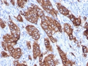 HER2 Antibody Breast Carcinoma Tubular IHC. Immunohistochemistry analysis of FFPE human breast carcinoma tissue using HER-2 Antibody (clone ERBB2/3093) demonstrates strong HRP-DAB brown membranous staining along elongated, tubular tumor structures, consistent with ErbB2 / HER2 expression as a cell surface receptor, while surrounding stromal tissue shows minimal signal; nuclei are counterstained blue. HIER: boil tissue sections in pH 9 10 mM Tris with 1 mM EDTA for 10-20 min and allow to cool before testing.