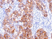 HER2 Antibody Breast Tumor Patchy IHC. Immunohistochemistry analysis of FFPE human breast carcinoma tissue using HER-2 Antibody (clone ERBB2/3093) highlights patchy yet distinct HRP-DAB brown membranous staining across tumor cell groups, reflecting variable ErbB2 / HER2 expression within the tumor microenvironment, while adjacent stromal regions remain largely negative; nuclei are counterstained blue. HIER: boil tissue sections in pH 9 10 mM Tris with 1 mM EDTA for 10-20 min and allow to cool before testing.