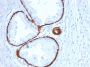 IHC staining of FFPE human prostate carcinoma with Cytokeratin 14 antibody (clone KRT14/2375). HIER: boil tissue sections in pH 9 10mM Tris with 1mM EDTA for 20 min and allow to cool before testing.