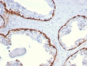 IHC staining of FFPE human prostate carcinoma with CK15 antibody (clone KRT15/2959). HIER: boil tissue sections in pH 9 10mM Tris with 1mM EDTA for 10-20 min and allow to cool before testing.