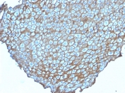 Desmoglein 3 Antibody Squamous Cell Junction IHC. Immunohistochemistry staining of FFPE human esophageal carcinoma tissue using HuProt validated monoclonal clone DSG3/2838 demonstrates strong membranous HRP-DAB brown staining outlining malignant squamous epithelial cells, consistent with localization of Desmoglein 3 / DSG3 at desmosomal junctions within stratified epithelial-derived carcinoma tissue. The staining prominently highlights epithelial cell-cell adhesion architecture characteristic of squamous differentiation-associated tumors. HIER: boil tissue sections in pH 9 10mM Tris with 1mM EDTA for 10-20 min and allow to cool before testing.