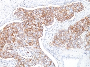 EpCAM Antibody Ber-EP4 Breast Carcinoma IHC. Immunohistochemistry staining of FFPE human breast carcinoma with EpCAM antibody (clone Ber-EP4). HIER: boil tissue sections in pH 9 10mM Tris with 1mM EDTA for 10-20 min and allow to cool before testing.