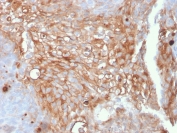 Immunohistochemistry of Uroplakin 1A antibody in human urothelial carcinoma. Formalin-fixed, paraffin-embedded human urothelial carcinoma tissue was stained with microarray validated Uroplakin 1A antibody (clone UPK1A/2925) following heat-induced epitope retrieval by boiling in pH 9 10 mM Tris with 1 mM EDTA for 10-20 minutes and cooling prior to testing. HRP-DAB brown chromogenic signal demonstrates strong membranous staining in tumor cells, consistent with apical membrane localization and urothelial differentiation associated with Uroplakin 1A, while surrounding stromal cells show minimal background staining.