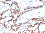 MSH2 Antibody (clone MSH2/2622). Immunohistochemistry analysis of FFPE human colon carcinoma using MSH2 antibody (clone MSH2/2622). Strong nuclear brown chromogenic staining identifies MutS homolog 2 / MSH2-positive tumor epithelial cells within the carcinoma, consistent with nuclear localization of this DNA mismatch repair protein. Heat-induced epitope retrieval was performed by boiling tissue sections in pH 9 10mM Tris with 1mM EDTA for 20 minutes followed by cooling prior to staining.