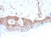 MSH2 Antibody (clone MSH2/2622). Immunohistochemistry analysis of FFPE human basal cell carcinoma using MSH2 antibody (clone MSH2/2622). Strong nuclear brown chromogenic staining identifies MutS homolog 2 / MSH2-positive tumor cells, consistent with nuclear localization of this DNA mismatch repair protein. Heat-induced epitope retrieval was performed by boiling tissue sections in pH 9 10mM Tris with 1mM EDTA for 20 minutes followed by cooling prior to staining.
