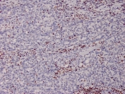 MSH2 Antibody (clone MSH2/2622). Immunohistochemistry analysis of FFPE human colon tissue from a Lynch syndrome patient using MSH2 antibody (clone MSH2/2622). Tumor cells show loss of nuclear MSH2 staining, while surrounding non-neoplastic stromal and inflammatory cells retain nuclear brown chromogenic signal and serve as internal positive controls. Heat-induced epitope retrieval was performed by boiling tissue sections in pH 9 10mM Tris with 1mM EDTA for 20 minutes followed by cooling prior to staining.