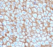 Immunohistochemistry of DSG3 Antibody Mouse Monoclonal CFM6-1 in human esophageal carcinoma tissue. Formalin-fixed, paraffin-embedded esophageal carcinoma demonstrates strong membranous staining of tumor epithelial cells, consistent with Desmoglein 3 localization at desmosomal cell-cell junctions in stratified squamous epithelium-derived malignancy. Heat-induced epitope retrieval was performed by boiling tissue sections in pH 9 10mM Tris with 1mM EDTA for 10-20 minutes followed by cooling prior to staining. The mouse monoclonal antibody clone CFM6-1 was used as the primary antibody.