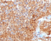Immunohistochemistry of UPK1A antibody in human urothelial carcinoma. Formalin-fixed, paraffin-embedded human urothelial carcinoma tissue was stained with mouse monoclonal Uroplakin 1A antibody (clone TTSP21-1) following heat-induced epitope retrieval by boiling in pH 9 10 mM Tris with 1 mM EDTA for 10-20 minutes and cooling prior to testing. HRP-DAB brown chromogenic signal demonstrates strong membranous and cytoplasmic staining in tumor cells, consistent with urothelial differentiation and apical membrane localization of Uroplakin 1A, while surrounding stromal elements show minimal staining.