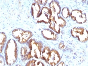 Prostate Specific Acid Phosphatase Antibody Human Prostate Carcinoma IHC. Immunohistochemistry staining of FFPE human prostate carcinoma tissue using Prostate Specific Acid Phosphatase Antibody / Prostate Cancer Marker Antibody (clone PASE/4LJ) demonstrates strong cytoplasmic and apical membranous HRP-DAB brown staining within malignant gland-forming epithelial cells. The staining pattern is consistent with expression of Prostate Specific Acid Phosphatase (ACP3/PAP), a well-established marker of prostate epithelial differentiation and prostate-derived malignancies. Robust immunoreactivity within neoplastic glandular structures supports the utility of PAP detection for identification of prostatic lineage and evaluation of prostate carcinoma specimens. Expression of Prostate Specific Acid Phosphatase remains an important feature in prostate pathology and cancer research applications involving tumor classification and differentiation studies. HIER: boil tissue sections in pH 9 Tris-EDTA buffer (10 mM Tris, 1 mM EDTA) for 20 minutes and allow to cool before staining.