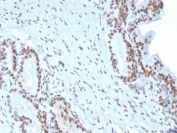 BMI1 Antibody Prostate Carcinoma IHC. Immunohistochemistry analysis of FFPE human prostate carcinoma tissue using BMI1 antibody clone BMI1/2823. Tumor epithelial cell nuclei demonstrate strong HRP-DAB brown staining consistent with the chromatin-associated localization of BMI1 in polycomb-mediated transcriptional repression, stem cell renewal signaling, and epigenetic regulatory pathways associated with proliferative prostate carcinoma tissue. Nuclei are counterstained blue. Heat-induced epitope retrieval was performed by boiling tissue sections in pH9 10 mM Tris with 1 mM EDTA for 20 minutes followed by cooling prior to staining.