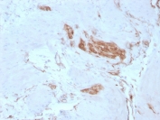 SPTAN1 Antibody for IHC staining of FFPE human colon tissue. HRP-DAB brown cytoplasmic staining is observed in epithelial and stromal cells, consistent with the submembranous cytoskeletal localization of Spectrin alpha chain, non-erythrocytic 1 (Alpha II Spectrin / SPTAN1). The rabbit monoclonal antibody clone SPTAN1/3351 was used for detection. HIER: boil tissue sections in pH 9 10mM Tris with 1mM EDTA for 20 min and allow to cool before testing.