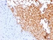 Immunohistochemistry of Alpha II Spectrin antibody in human lung tissue. FFPE human lung shows cytoplasmic HRP-DAB brown staining in epithelial and inflammatory cells, consistent with SPTAN1 localization along the submembranous cytoskeleton. Clone SPTAN1/3352 was used following heat-induced epitope retrieval by boiling tissue sections in pH 6, 10 mM citrate buffer for 20 minutes and allowing sections to cool prior to staining.
