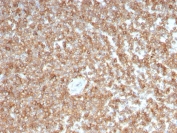 GM-CSF Antibody Lymphoid Tissue IHC. Immunohistochemistry of Granulocyte macrophage colony stimulating factor / CSF2 in FFPE human spleen tissue using mouse monoclonal GM-CSF antibody, clone CSF2/3403. HRP-DAB brown staining highlights cytoplasmic labeling in immune cell populations within splenic white pulp regions, consistent with cytokine expression in lymphoid tissue, while surrounding areas show lower background staining and nuclei are counterstained blue. Heat induced epitope retrieval was performed by boiling tissue sections in pH 9 10 mM Tris with 1 mM EDTA for 10-20 min followed by cooling prior to staining.