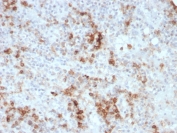 GM-CSF Antibody Immune Cell Distribution IHC. Immunohistochemistry of Granulocyte macrophage colony stimulating factor / CSF2 in FFPE human spleen tissue using mouse monoclonal GM-CSF antibody, clone CSF2/3403. HRP-DAB brown staining highlights scattered cytoplasmic labeling in subsets of immune cells within splenic tissue, with a focal and heterogeneous distribution consistent with cytokine-producing cell populations, while surrounding lymphoid cells show lower staining and nuclei are counterstained blue. Heat induced epitope retrieval was performed by boiling tissue sections in pH 9 10 mM Tris with 1 mM EDTA for 10-20 min followed by cooling prior to staining.