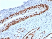 IHC analysis of p53 / TP53 antibody in human colon carcinoma tissue. Formalin-fixed, paraffin-embedded human colon carcinoma shows strong nuclear HRP-DAB brown chromogenic staining in tumor epithelial cells, consistent with accumulation of p53 protein, while adjacent stromal cells show minimal staining. Heat-induced epitope retrieval was performed by boiling tissue sections in pH 9 10mM Tris with 1mM EDTA for 10-20 min followed by cooling prior to staining.