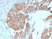 UPK1B Antibody for IHC. Immunohistochemistry analysis of Uroplakin 1B / UPK1B antibody in human urothelial carcinoma tissue using clone UPK1B/3102. FFPE sections demonstrate strong HRP-DAB brown membranous staining in tumor epithelial cells, with prominent apical surface labeling consistent with organized urothelial plaque structures. This Urothelial Plaque Structural Protein Antibody highlights the characteristic plaque-associated membrane pattern of UPK1B in urothelial tumor cells. HIER: boil tissue sections in pH 9 10mM Tris with 1mM EDTA for 20 minutes followed by cooling prior to staining.