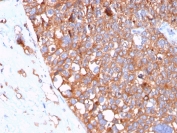 UPK1B Antibody for IHC. Immunohistochemistry analysis of Uroplakin 1B / UPK1B antibody in human urothelial carcinoma tissue using clone UPK1B/3102. FFPE sections show diffuse HRP-DAB brown membranous staining in tumor epithelial cells with a dense, plaque-like surface pattern, consistent with the known localization of UPK1B within urothelial plaque structures. This Urothelial Plaque Structural Protein Antibody highlights the extensive membrane organization and plaque-associated distribution of UPK1B in urothelial tumor cells. HIER: boil tissue sections in pH 9 10mM Tris with 1mM EDTA for 20 minutes followed by cooling prior to staining.