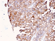 UPK1B Antibody for IHC. Immunohistochemistry analysis of Uroplakin 1B / UPK1B antibody in human urothelial carcinoma tissue using clone UPK1B/3081. FFPE sections demonstrate strong HRP-DAB brown membranous staining in tumor epithelial cells with well-defined cell borders, consistent with localization of this tetraspanin-like membrane protein at the plasma membrane. This Membrane Tetraspanin-like Protein Antibody highlights the characteristic membrane organization and cell surface pattern of UPK1B in urothelial tumor cells. HIER: boil tissue sections in pH 9 10mM Tris with 1mM EDTA for 20 minutes followed by cooling prior to staining.