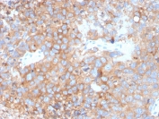 Uroplakin 1B Antibody. Immunohistochemistry analysis of Uroplakin 1B / UPK1B antibody in human urothelial carcinoma tissue using clone UPK1B/3273. FFPE sections show diffuse HRP-DAB brown membranous staining in tumor epithelial cells with partial luminal surface accentuation, consistent with apical membrane localization in urothelial cells. This Urothelial Apical Surface Protein Antibody highlights the polarized cell surface distribution of UPK1B within urothelial tumor epithelium. HIER: boil tissue sections in pH 9 10mM Tris with 1mM EDTA for 20 minutes followed by cooling prior to staining.