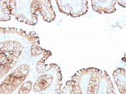 Villin Antibody. Immunohistochemistry analysis of Villin-1 (VIL1) in FFPE human colon carcinoma using Villin Antibody / Intestinal Differentiation Marker Antibody with mouse monoclonal clones VIL1/1314 and VIL1/2376. Strong HRP-DAB brown staining is observed in tumor epithelial cells with prominent apical and luminal accentuation, consistent with differentiated enterocyte-like features. The staining highlights areas of maintained epithelial maturation within the carcinoma, supporting Villin as a marker of intestinal differentiation state and enterocyte lineage in colorectal tumors.