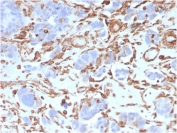 Vimentin Antibody / Mechanotransduction Marker Antibody IHC. Immunohistochemistry analysis of FFPE human colon carcinoma tissue using Vimentin antibody shows strong HRP-DAB brown cytoplasmic staining in stromal and spindle-shaped mesenchymal cells within the tumor microenvironment, with minimal staining in most tumor epithelial cells. The rabbit monoclonal clone VIM/3736 highlights elongated, filamentous cytoplasmic structures aligned along cellular axes, consistent with force-bearing cytoskeletal organization. The distribution and morphology of Vimentin-positive cells support its role in cytoskeletal tension and mechanical signaling within tumor-associated stromal compartments.