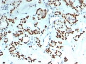 PAX8 Antibody / Mullerian Epithelial Marker Antibody immunohistochemistry in human thyroid tissue showing strong nuclear HRP-DAB brown staining in follicular epithelial cells. Paired box protein Pax-8 (PAX8) expression is localized to nuclei lining thyroid follicles, with clear staining of epithelial cells surrounding colloid-filled lumina and minimal signal in stromal components. While this antibody is positioned as a Mullerian epithelial marker, the observed nuclear positivity in thyroid tissue reflects the broader epithelial lineage expression profile of PAX8. The staining pattern demonstrates crisp nuclear localization with hematoxylin counterstain highlighting negative cells. HIER: boil tissue sections in pH 9 10mM Tris with 1mM EDTA for 20 min and allow to cool before testing.