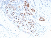 p40 Antibody. Immunohistochemistry analysis of FFPE human breast carcinoma tissue demonstrates focal HRP-DAB brown nuclear staining in tumor cell clusters, while surrounding stromal elements remain largely negative. The nuclear-restricted pattern highlights epithelial cells with basal-like characteristics and supports use of this antibody as an epithelial stratification and differentiation marker, reflecting deltaNp63-associated regulation of epithelial layering and cell state. Staining is heterogeneous across tumor regions, allowing identification of p40-positive subpopulations within the carcinoma. Heat-induced epitope retrieval was performed by boiling tissue sections in pH 9 10mM Tris with 1mM EDTA for 20 minutes followed by cooling prior to antibody incubation.