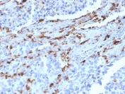 Napsin A Antibody Lung Adenocarcinoma IHC. Immunohistochemistry analysis of Napsin A (NAPSA) expression in FFPE human lung adenocarcinoma demonstrates granular cytoplasmic HRP-DAB brown staining in tumor epithelial cells with minimal background in surrounding stromal regions. Clone NAPSA/3309, a protein microarray validated mouse monoclonal antibody, supports selective detection of Napsin A consistent with its role as a pulmonary epithelial differentiation marker. HIER was performed by boiling tissue sections in pH 9 10mM Tris with 1mM EDTA for 10-20 minutes followed by cooling at RT for 20 minutes prior to staining.