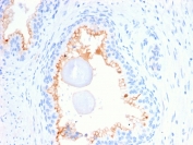 IHC staining of FFPE human prostate carcinoma with CD10 antibody (clone MME/2580). HIER: boil tissue sections in pH 9 10mM Tris with 1mM EDTA for 20 min and allow to cool before testing.