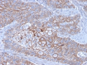 E-Cadherin Antibody Breast Carcinoma IHC. Immunohistochemistry staining of FFPE human breast carcinoma with E-Cadherin antibody (clone CDH1/3256). HIER: boil tissue sections in pH 9 10mM Tris with 1mM EDTA for 20 min and allow to cool before testing.