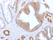 E-cadherin Antibody Clone SPM471 Prostate Carcinoma IHC. Immunohistochemistry analysis of Cadherin 1 / CDH1 expression in FFPE human prostate carcinoma using clone SPM471 antibody, showing membranous HRP-DAB brown staining in tumor epithelial cells with clear cell-cell junction localization, while surrounding stromal tissue remains largely negative. HIER: boil tissue sections in pH 9 10mM Tris with 1mM EDTA for 20 min and allow to cool before testing. Signal highlights epithelial differentiation and junctional organization in carcinoma tissue.