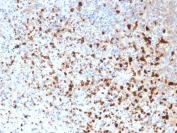 Immunohistochemistry of HSV1 Antibody Clone 10A3 in human cervix tissue. FFPE human cervix sections were subjected to heat-induced epitope retrieval by boiling in pH 9, 10 mM Tris with 1 mM EDTA for 10-20 minutes followed by cooling at room temperature for 20 minutes. The mouse monoclonal HSV1 antibody clone 10A3 was used as the detecting antibody. HRP-DAB brown staining is observed in scattered epithelial and stromal cells, with signal localized predominantly to the nucleus and cytoplasm of positive cells, while surrounding cells show minimal background staining. The staining pattern is consistent with Herpes simplex virus type 1 antigen expression in cervix tissue.