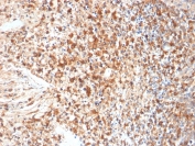 Immunohistochemistry of HSV1 antibody in human cervix tissue. FFPE human cervix sections were subjected to heat-induced epitope retrieval by boiling in pH 9, 10 mM Tris with 1 mM EDTA for 10-20 minutes followed by cooling at room temperature for 20 minutes. The mouse monoclonal HSV1 antibody clone HSVI/2095 was used as the detecting antibody. HRP-DAB brown staining is observed in numerous epithelial and stromal cells, with signal localized predominantly to the nucleus and cytoplasm of positive cells, while adjacent cells show minimal background staining. The staining pattern is consistent with Herpes simplex virus type 1 antigen expression in cervix tissue.