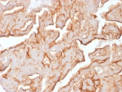 Immunohistochemistry analysis of MUC16 Antibody Mouse Monoclonal (Clone OCA125/1900) in FFPE human ovarian carcinoma tissue. Strong membranous and apical cytoplasmic HRP-DAB brown staining is observed in malignant epithelial cells forming glandular and papillary structures, consistent with MUC16 / CA125 overexpression in ovarian carcinoma, while adjacent stromal cells remain largely negative. Heat-induced epitope retrieval was performed in pH 9 Tris-EDTA buffer (10mM Tris, 1mM EDTA) for 20 minutes followed by cooling prior to staining.