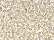 FABP1 Antibody - Microarray Validated Immunohistochemistry. IHC staining of FFPE human liver carcinoma with FABP1 antibody (clone FABP1/3482). HIER: boil tissue sections in pH 9 10mM Tris with 1mM EDTA for 20 min and allow to cool before testing.