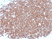 TdT Antibody Human Thymus Tissue Immunohistochemistry. IHC staining of FFPE human thymus with TdT antibody (clone TDT/1393). HIER: boil tissue sections in pH 9 10mM Tris with 1mM EDTA for 20 min and allow to cool before testing.