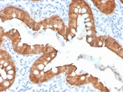Villin Antibody. Immunohistochemistry analysis of Villin-1 (VIL1) in FFPE human colon using Villin Antibody / Actin-Binding Cytoskeletal Protein Antibody with recombinant rabbit monoclonal clone VIL1/4107R. Strong HRP-DAB brown staining is observed in the apical cytoplasm and membrane of colonic epithelial cells, highlighting regions of active actin filament organization along the luminal surface. The staining pattern is consistent with Villin localization to actin-rich structures and supports its role as an actin-binding cytoskeletal protein involved in filament remodeling within epithelial cells.