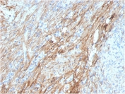 IHC staining of FFPE human lung with Fibronectin antibody (clone FN1/3029). HIER: boil tissue sections in pH 9 10mM Tris with 1mM EDTA for 20 min and allow to cool before testing.