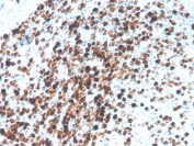 TOP2A Antibody / Topoisomerase II Alpha Antibody (clone TOP2A/4397R). Immunohistochemistry analysis of FFPE human tonsil tissue demonstrates strong nuclear staining consistent with expression of the Topoisomerase II alpha protein in proliferating lymphoid cells. Staining is predominantly localized to nuclei within germinal center lymphocytes, reflecting the role of Topoisomerase II alpha as a DNA replication enzyme highly expressed in actively dividing cells. The Topoisomerase II Alpha Antibody highlights proliferative lymphoid populations within tonsillar tissue, producing a distinct nuclear immunoreactivity pattern typical of cell cycle associated proteins. Antigen retrieval was performed by boiling tissue sections in pH 9 Tris-EDTA buffer prior to immunohistochemistry staining.