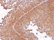 PAI-RBP1 Antibody Urothelial Carcinoma IHC. Immunohistochemistry analysis of FFPE human urothelial carcinoma tissue stained with PAI-RBP1 Antibody demonstrates diffuse cytoplasmic HRP-DAB brown staining throughout malignant epithelial cell populations, consistent with PAI-RBP1 / SERBP1-associated translational regulatory pathway expression. This SERPINE1 RNA binding protein antibody highlights post-transcriptional signaling and stress-response-associated cellular regulation within urothelial tumor tissue. HIER: boil tissue sections in pH 9 10mM Tris with 1mM EDTA for 20 min and allow to cool before testing.