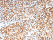 PAI-RBP1 Antibody Urothelial Cancer IHC. Immunohistochemistry analysis of FFPE human urothelial carcinoma tissue stained with PAI-RBP1 Antibody demonstrates widespread cytoplasmic HRP-DAB brown staining across neoplastic epithelial cell populations, consistent with PAI-RBP1 / SERBP1-associated RNA regulatory and translational control pathway expression. This SERPINE1 RNA binding protein antibody highlights post-transcriptional signaling networks and cellular adaptation-associated regulatory biology in urothelial tumor tissue. HIER: boil tissue sections in pH 9 10mM Tris with 1mM EDTA for 20 min and allow to cool before testing.