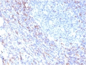 ZAP70 Antibody / T-cell Receptor Signaling Antibody. Immunohistochemistry analysis of formalin-fixed, paraffin-embedded human tonsil tissue using ZAP70 Antibody / T-cell Receptor Signaling Antibody. Antigen retrieval was performed by boiling sections in pH 9 Tris-EDTA buffer for 20 minutes followed by cooling. Cytoplasmic HRP-DAB brown staining is observed in lymphoid cells within tonsillar tissue, consistent with Zeta-chain-associated protein kinase 70 (ZAP70) expression in T lymphocytes and its established role in T-cell receptor signaling. The staining highlights lymphocyte-rich regions and supports use of ZAP70 as a marker of receptor-mediated immune signaling within lymphoid tissue architecture.
