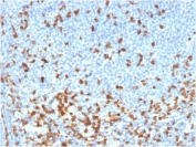ZAP70 Antibody / T-cell Receptor Signaling Antibody. Immunohistochemistry analysis of formalin-fixed, paraffin-embedded human lymphoma tissue using ZAP70 Antibody / T-cell Receptor Signaling Antibody. Antigen retrieval was performed by boiling sections in pH 9 Tris-EDTA buffer for 20 minutes followed by cooling. Cytoplasmic HRP-DAB brown staining is observed in malignant lymphoid cells and surrounding lymphocyte populations, consistent with Zeta-chain-associated protein kinase 70 (ZAP70) expression in lymphoid-derived cells and its role in T-cell receptor signaling. The staining pattern highlights tumor-associated lymphoid cells and supports the use of ZAP70 for evaluating receptor-mediated signaling within lymphoma tissue architecture.