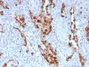 Napsin A Antibody for IHC. Immunohistochemistry analysis of Napsin A (NAPSA) expression in FFPE human lung adenocarcinoma demonstrates strong granular cytoplasmic HRP-DAB brown staining in tumor epithelial cells with minimal background in surrounding stromal regions. Clone NAPSA/3307 highlights alveolar epithelial differentiation consistent with expression in type II pneumocyte-derived cells, supporting identification of alveolar lineage within tumor tissue. HIER was performed by boiling tissue sections in pH 9 10mM Tris with 1mM EDTA for 20 minutes followed by cooling prior to staining.